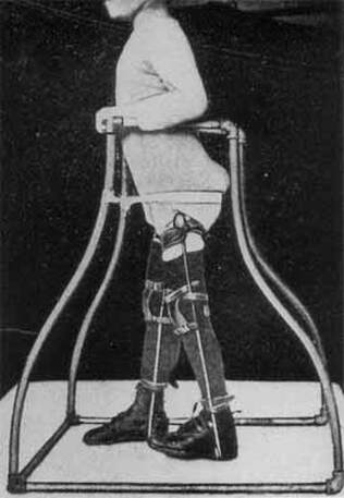 Leg irons on a child with polio