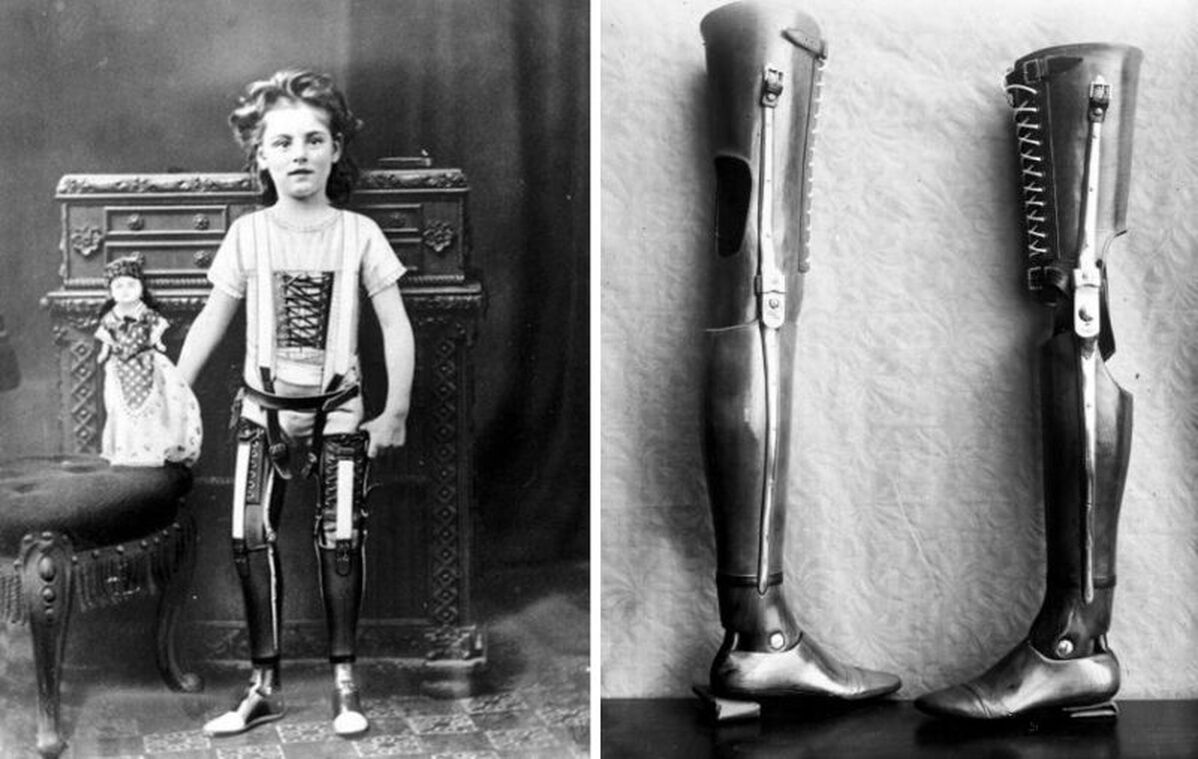 A Century-Old Prosthesis