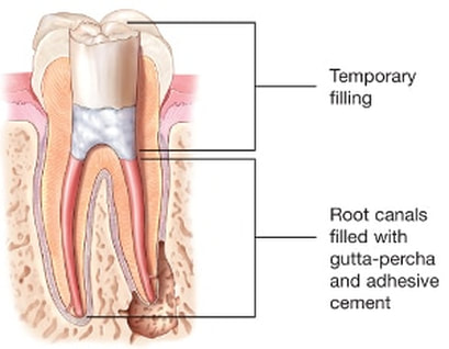 Gutta Percha for root canals
